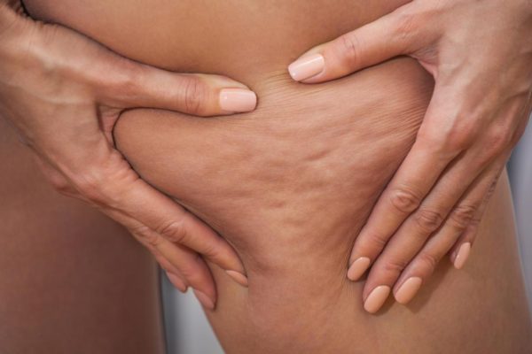 Cellulite; Causes and Home Treatments