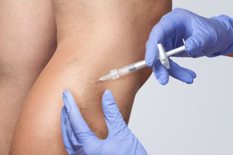 Microsclerotherapy for Treatment of Thread Veins on the Legs
